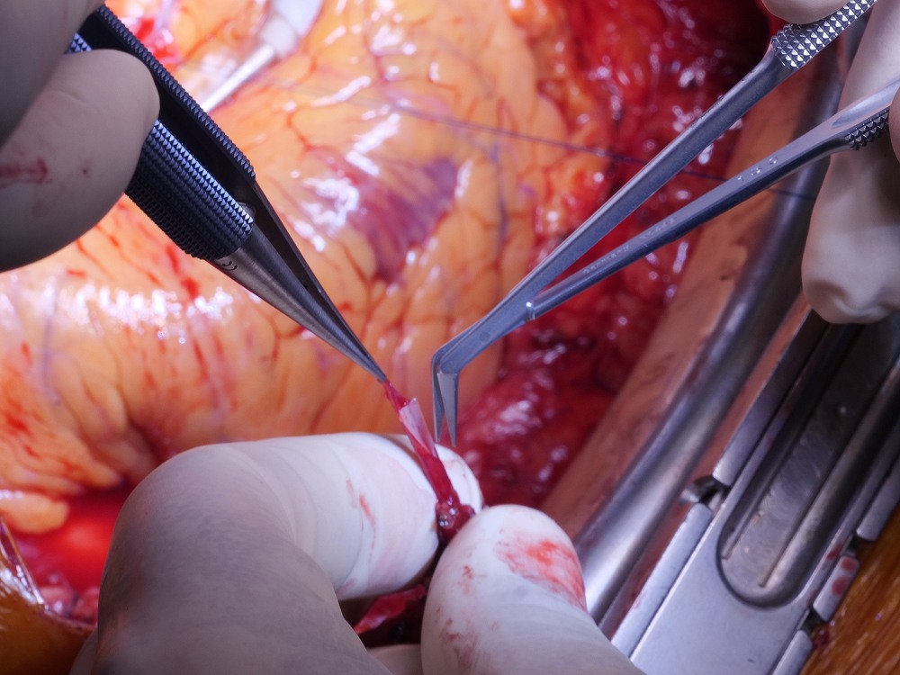 Doctors performing surgery under bright lights in an operating room